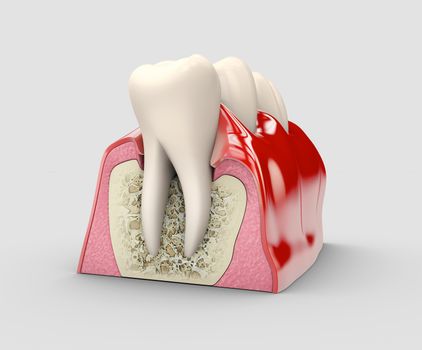 Human tooth, dental implant, stock 3d illustration