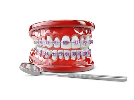 Teeth with brackets, Dental care concept 3d illustration.