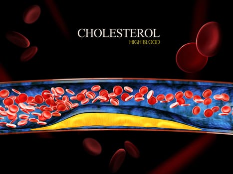 3d Illustration of blood cells with plaque buildup of cholesterol.