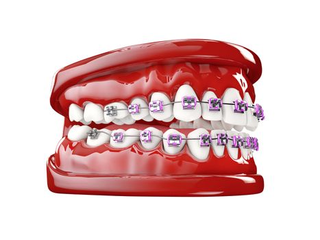Teeth with brackets, Dental care concept 3d illustration.