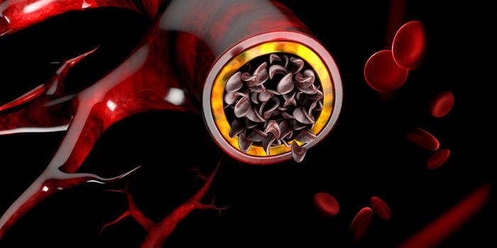 Sickle cell anemia, showing blood vessel with normal and deformated crescent. 3D illustration.