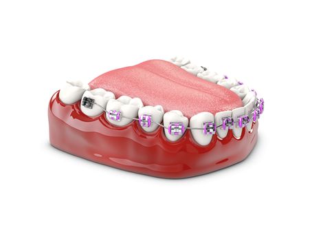 Teeth with brackets, Dental care concept 3d illustration.