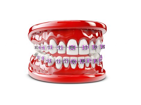 Teeth with brackets, Dental care concept 3d illustration.
