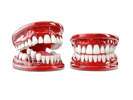 Tooth human implant. Dental concept 3d illustration.