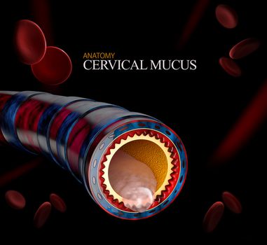 Bronchitis anatomy, mucus secreted as a chest cold as a 3D illustration.