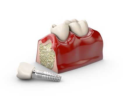 tooth dental implant model 3d illustration.