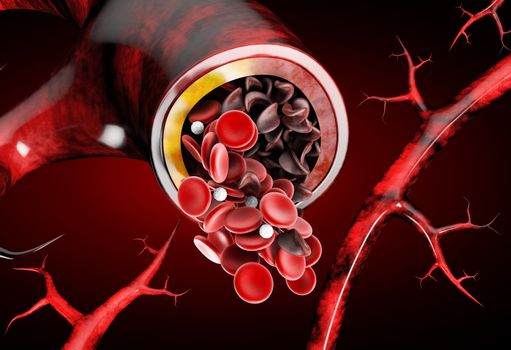 Sickle cell anemia, showing blood vessel with normal and deformated crescent 3D illustration.