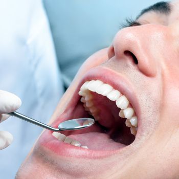 Macro close up of young man with open mouth showing healthy white teeth. Dentist hand checking teeth with mouth mirror.