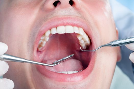 Extreme close up of human male mouth showing teeth.Dentist working with hatchet and mouth mirror on teeth.
