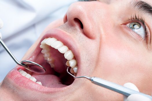 Extreme close up of Young man whitening teeth at dentist. Open human mouth showing teeth with hatchet and mouth mirror.