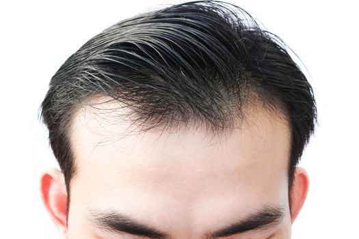 Young man serious hair loss problem for health care medical and shampoo product concept