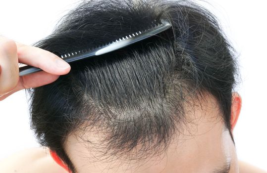 Young man serious hair loss problem for health care medical and shampoo product concept