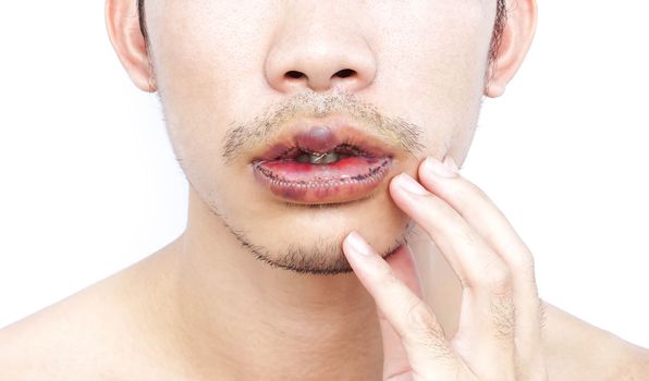 Closeup lips man upper and lower with reduction surgery, beauty concept