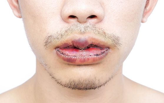 Closeup lips man upper and lower with reduction surgery, beauty concept