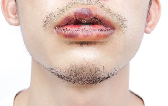 Closeup lips man upper and lower with reduction surgery, beauty concept