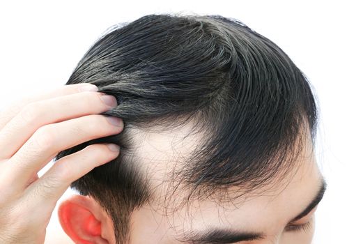 Young man serious hair loss problem for health care shampoo and beauty product concept