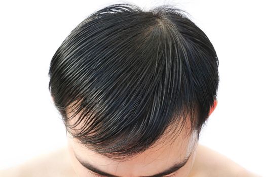 Young man serious hair loss problem for health care shampoo and beauty product concept