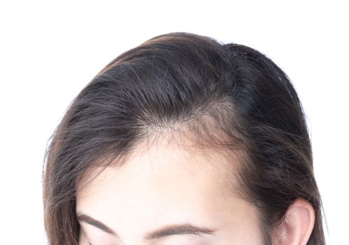 Woman serious hair loss problem for health care shampoo and beauty product concept