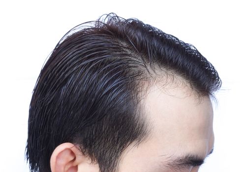 Young man serious hair loss problem for health care medical and shampoo product concept