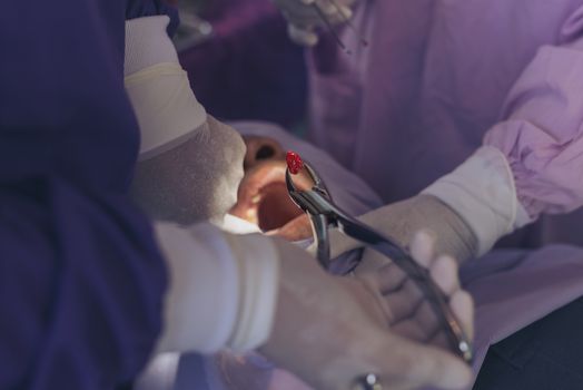 The dentist is removing the decaying tooth from the young man's mouth.