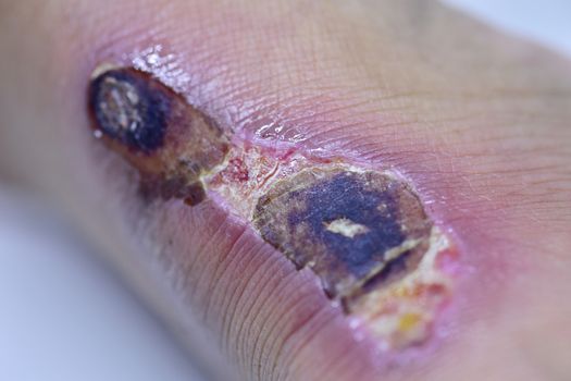 Closeup of blisters scab on man foot.
