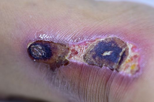 Closeup of blisters scab on man foot.