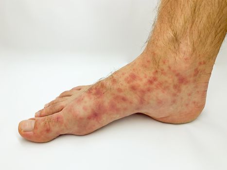 Close up of male's foot and toes with red rash desease on a white background. Stock image.