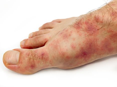 Close up of male's foot and toes with red rash desease isolated on a white background. Stock image.