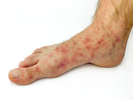 Close up of male's foot and toes with red rash desease isolated on a white background. Stock image.