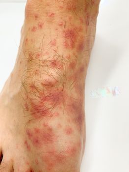 Close up of male's foot and toes with red rash desease on a white background. Stock image.