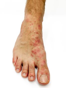 Close up of male's foot and toes with red rash desease isolated on a white background. Stock image.