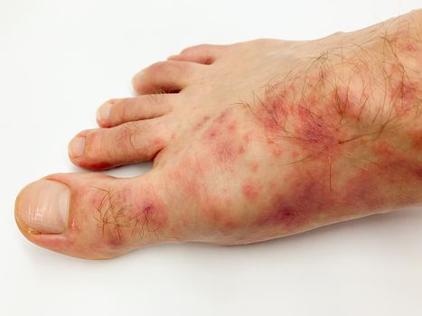 Close up of male's foot and toes with red rash desease on a white background. Stock image.