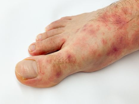 Close up of male's foot and toes with red rash desease on a white background. Stock image.