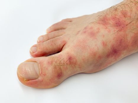 Close up of male's foot and toes with red rash desease on a white background. Stock image.