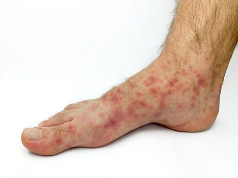 Close up of male's foot and toes with red rash desease isolated on a white background. Stock image.