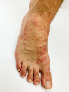 Close up of male's foot and toes with red rash desease on a white background. Stock image.