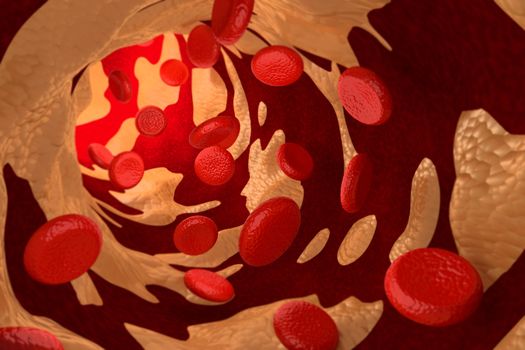 3D rendering of arteriosclerosis by cholesterol plaque.