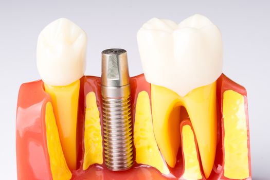 Set of Dentist's equipment tools, denture showing implant