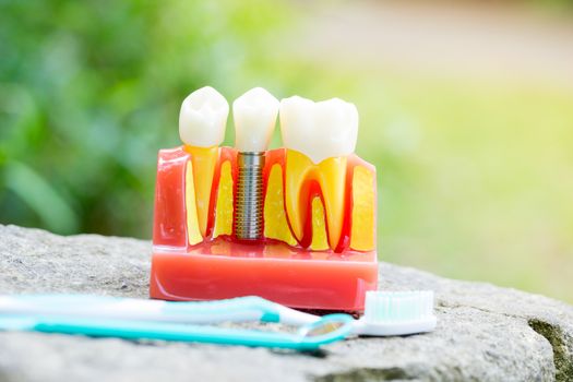 Set of Dentist's equipment tools, denture showing implant