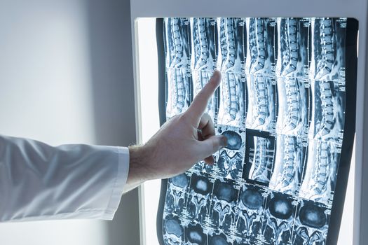 Medical doctor surgeon and neurologist examines a snapshot of a magnetic resonance imaging of the patient’s spine and its organs