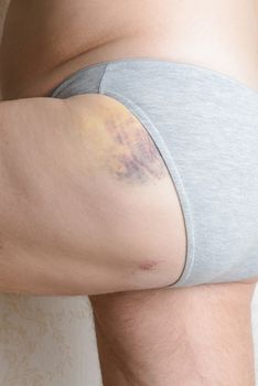 Man injured by dog bites in the buttock. The deep wounds left by the fangs are obvious. A blue hematoma covers the leg