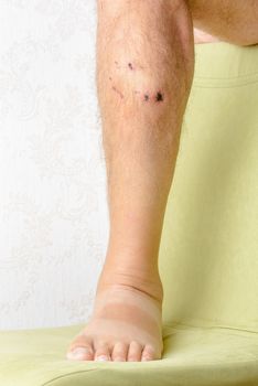 Man injured by dog bites in the leg. The deep wounds left by the fangs are obvious.
