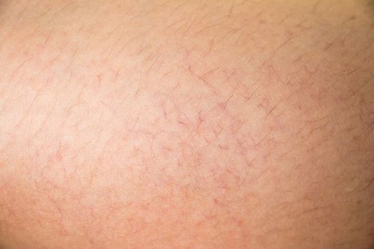 Closed up of vericose veins on female leg background