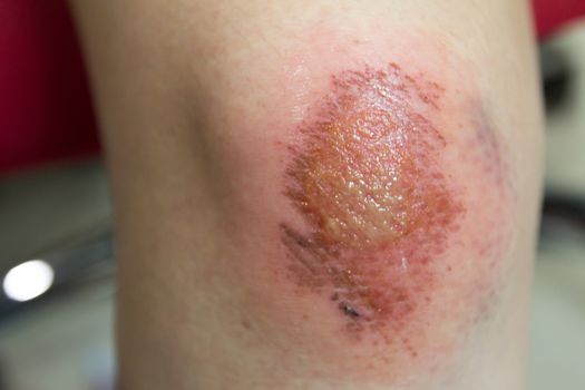 Fresh wound with lymph and blood on asian female knee background