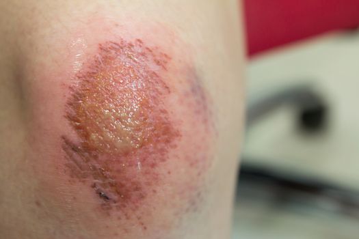 Fresh wound with lymph and blood on asian female knee background