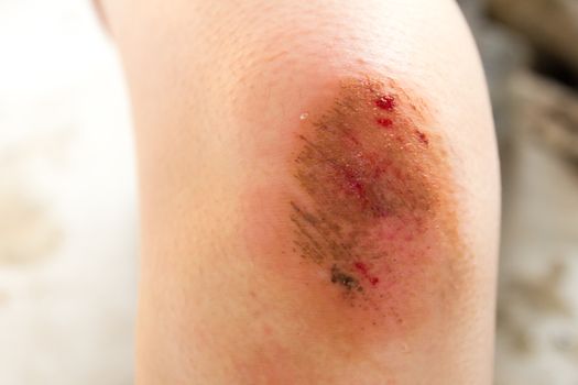 Bruised wound injury on woman knee background