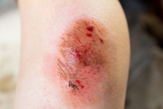 Bruised wound injury on woman knee background