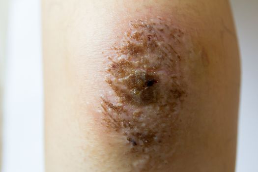 Closed up of red scab injury on woman knee background