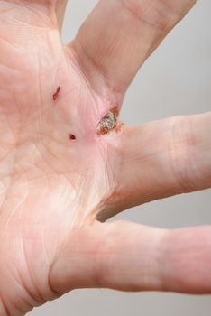 Man injured by dog bites in the hand. The deep wound left by the fangs between the fingers are obvious.