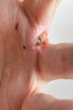 Man injured by dog bites in the hand. The deep wound left by the fangs between the fingers are obvious.